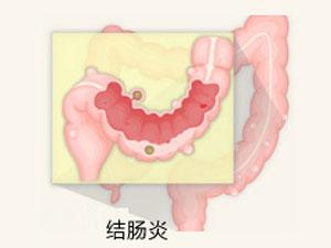 南寧治療結(jié)腸炎要花多少錢(qián)